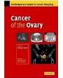 Cancer of the Ovary (Contemporary Issues in Cancer Imaging)